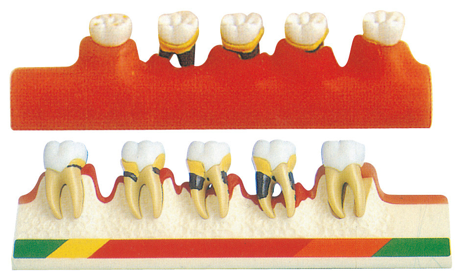 Il modello di malattia periodentale comprende 5 parti per la formazione delle scuole dentarie