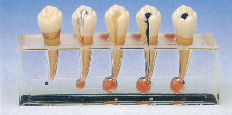 Il modello clinico di patologia di endodontica comprende 5 parti per addestramento della clinica