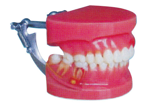 Generale di modello medico di malattia periodentale dei denti umani rossi e bianchi di dimostrazione