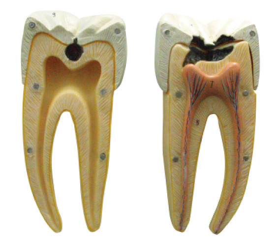 Nell'iniziale e nelle fasi avanzate del modello della carie dentale per l'apprendimento e prepararsi