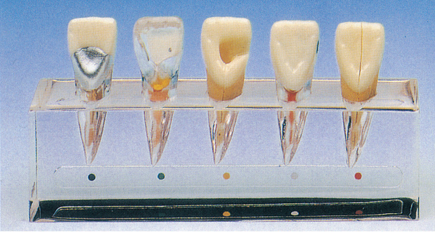 Modello clinico di serie di malattia del dente circa 5 parti per la formazione delle scuole dentarie