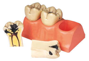 Modello umano diviso dei denti della malattia dentaria per internato e la formazione degli studenti