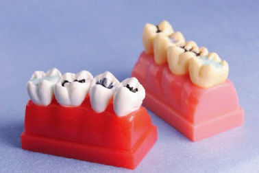 Modello umano dei denti per un modello dimostrativo dell'intarsio e del sigillante di 4 volte a grandezza naturale